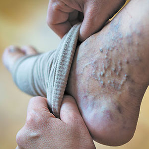 بیماری واریس